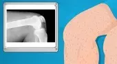 Operate Now! Knee Surgery