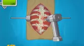 Operate Now! Scoliosis Surgery