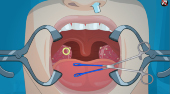 Operate Now! Tonsil Surgery
