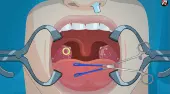 Operate Now! Tonsil Surgery