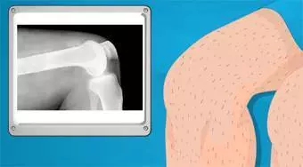 Operate Now! Knee Surgery